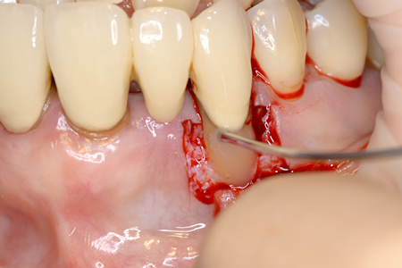 再生材料を用いた歯周形成外科